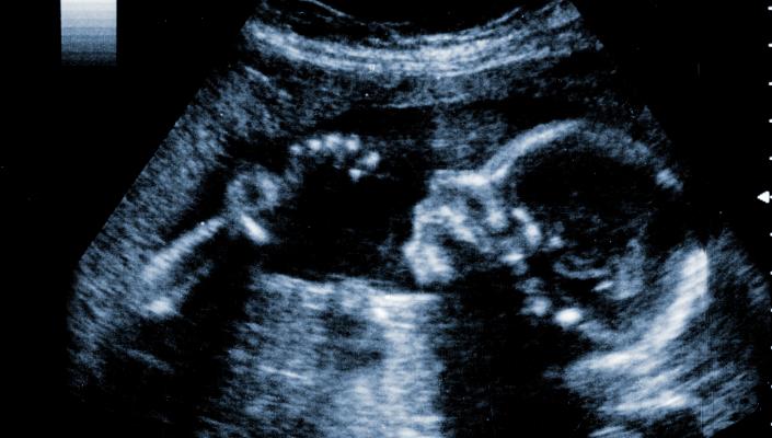 Ultrasound image of a fetus